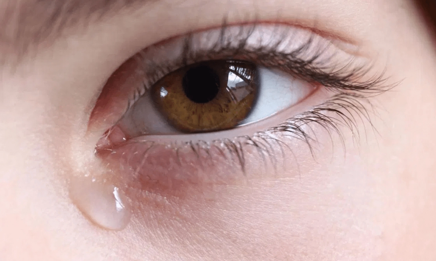 Frequent watering of the eyes