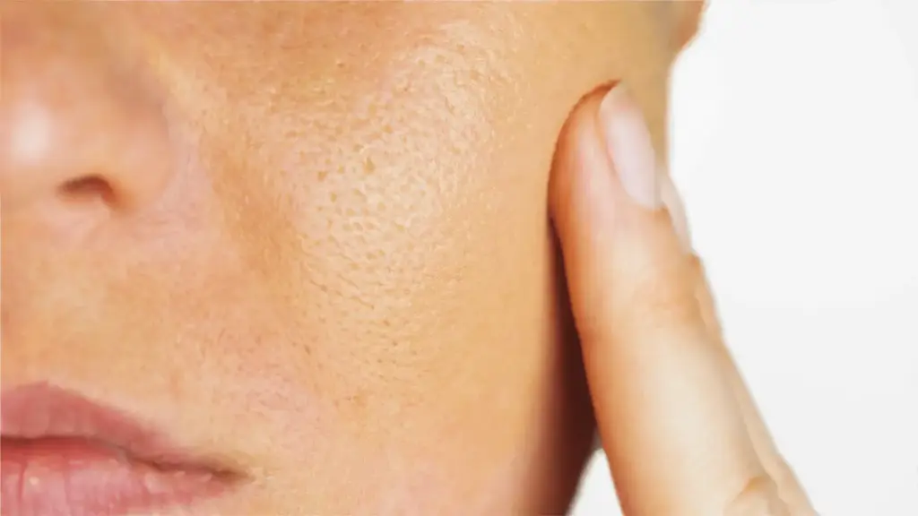 Natural Remedies: ఏం రాసినా ఓపెన్ పోర్స్ తగ్గట్లేదా? ఈ ప్యాక్స్ వేస్తే స్కిన్ మెరుస్తుంది