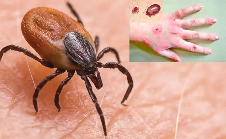 AP Health Alert: 144 scrub typhus cases since the new year