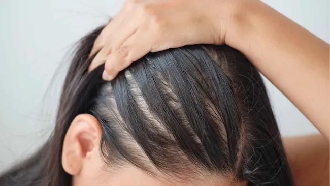 Hair Care: అలోప్సియా అరెటాకు ఇమ్యూనిటీ కణాలే కారణం