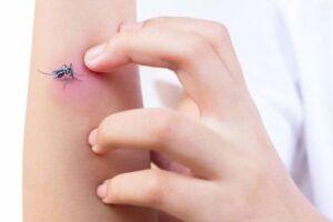 దోమ‌లు ఎక్కువ‌గా కుడుతున్నాయా?