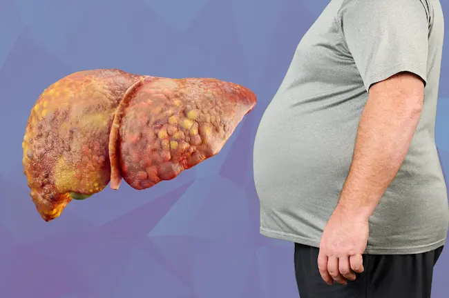 Fatty Liver : ఫ్యాటీ లివ‌ర్ తో బాధ‌ప‌డుతున్నారా..?