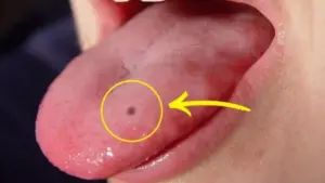 నాలుకపై మచ్చ: అదృష్టమా?