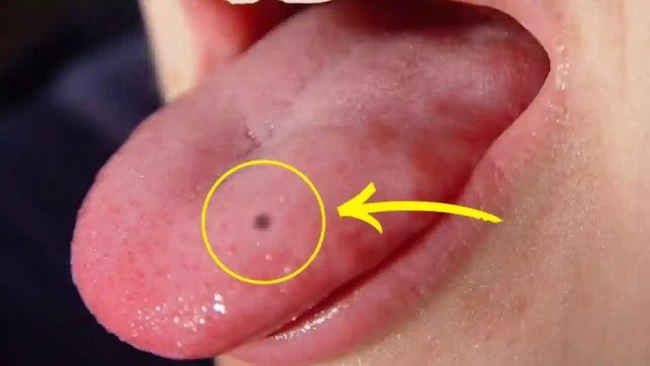 Beliefs Vs Science: నాలుకపై మచ్చ: అదృష్టమా?