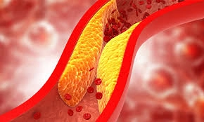 సన్నగా ఉన్నవారికీ అధిక కొలెస్ట్రాల్ ప్రమాదం!