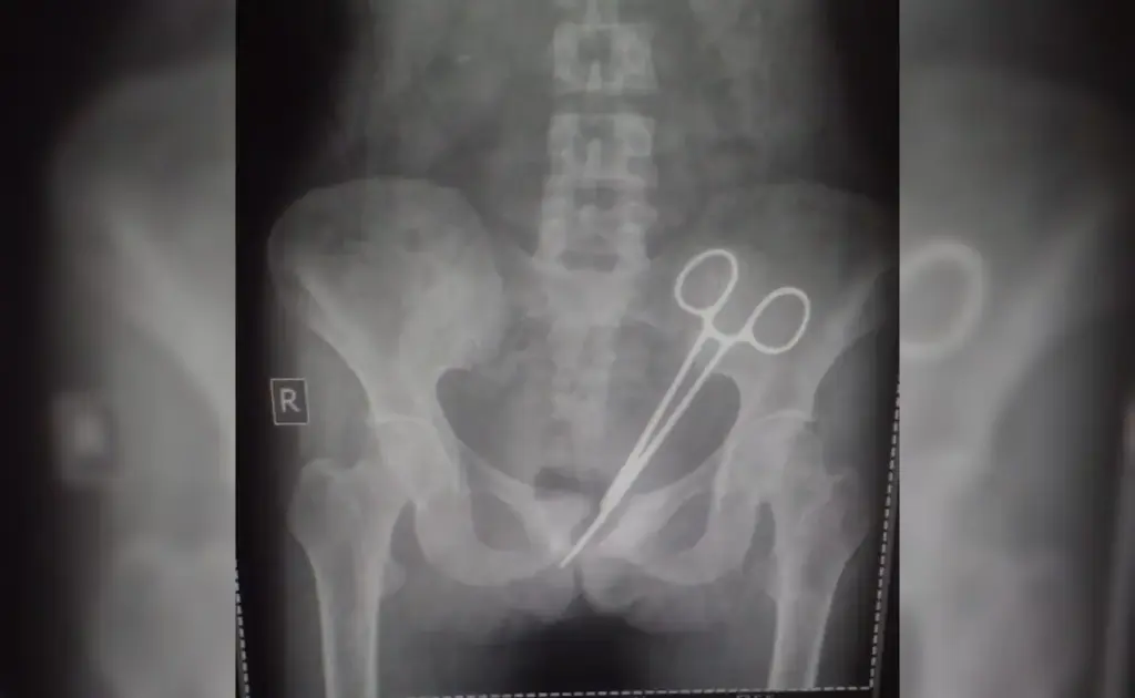 Kerala medical case : ఆపరేషన్ షాక్, మహిళ కడుపులో 5 ఏళ్లు మిగిలిన కత్తెర ఘటన