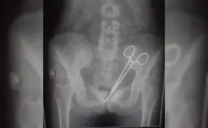 ఆపరేషన్ షాక్, మహిళ కడుపులో 5 ఏళ్లు మిగిలిన కత్తెర ఘటన