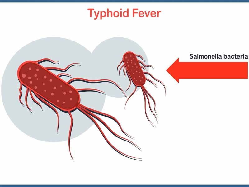 Typhoid : తెలంగాణలో పెరుగుతున్న టైఫాయిడ్ మరణాలు..జాగ్రత్త !!