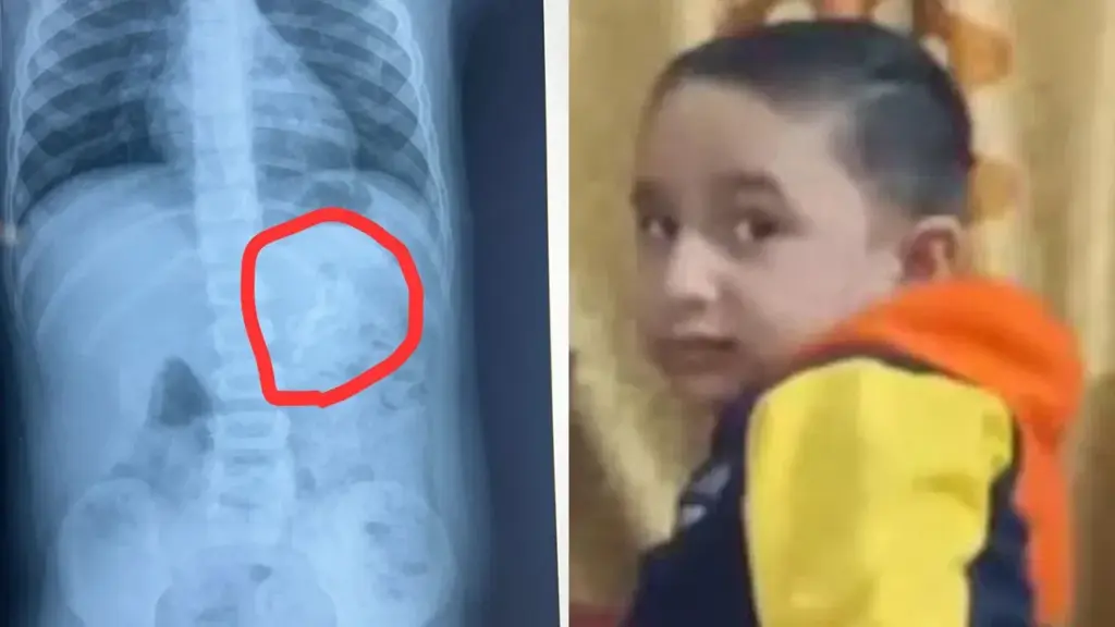 Ahmedabad: లంగ్స్ లోకెళ్ళిన హల్క్ బొమ్మ వైద్యులకే పెద్ద సవాలు