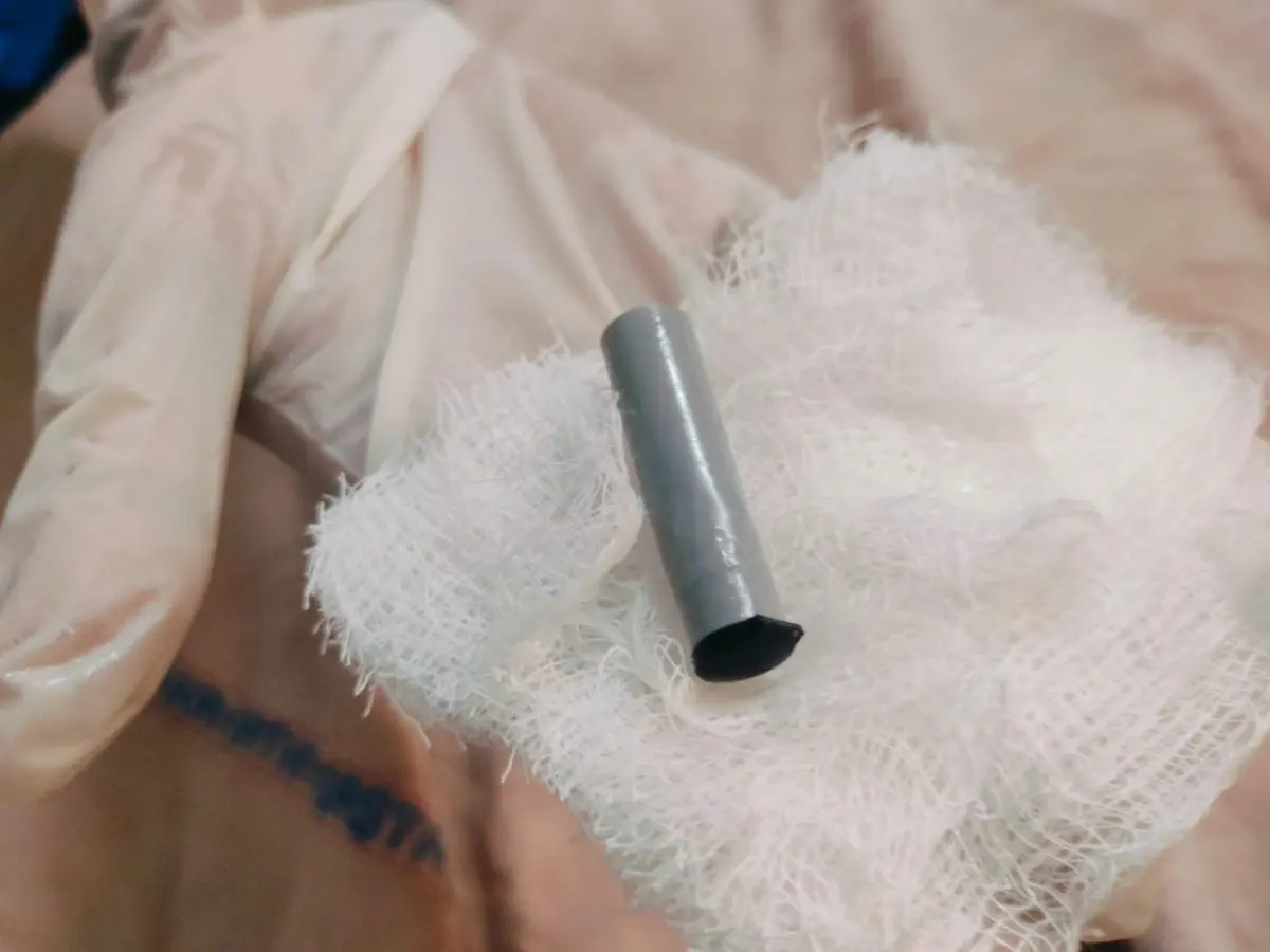 Mancherial: పెన్ను క్యాప్ మింగిన బాలుడు.. త్రుటిలో తప్పిన ప్రమాదం