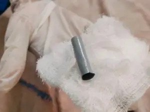 పెన్ను క్యాప్ మింగిన బాలుడు.. త్రుటిలో తప్పిన ప్రమాదం