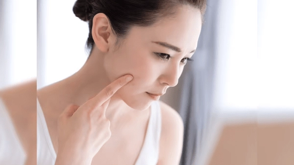 Period Acne: Are you getting pimples during that time of the month? If so, what should you do?