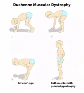 పిల్లల్లో కండరాల బలహీనతను గుర్తించడం ఎలా?