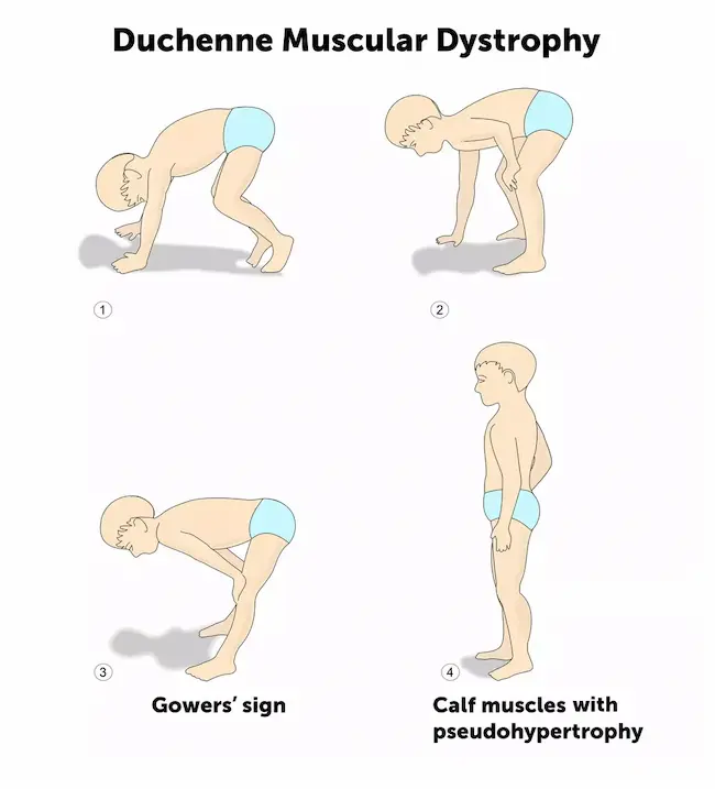 Duchenne Muscular Dystrophy: పిల్లల్లో కండరాల బలహీనతను గుర్తించడం ఎలా?