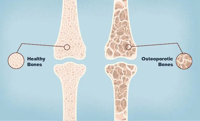 Osteoporosis: చిన్న వయసులోనే ఎముకల నొప్పులా?