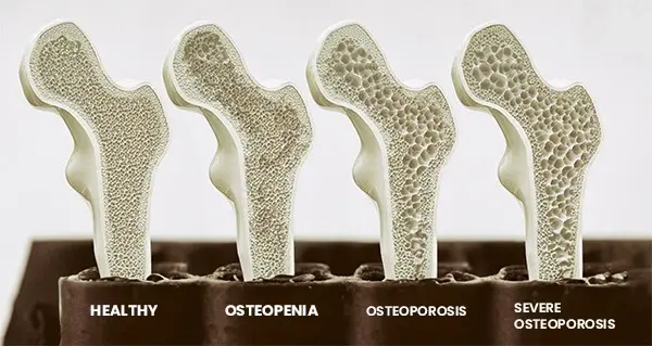 Osteoporosis