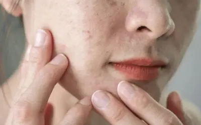 Period Acne: ఆ టైం లో మొటిమలు వస్తున్నాయా? అయితే ఏం చేయాలి?