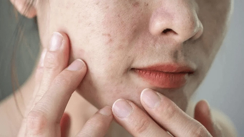 Period Acne: Are you getting pimples during that time of the month? If so, what should you do?